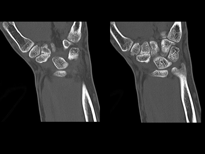 Figure 2 for case scaphotrapezoidal joint ( RID2254 )